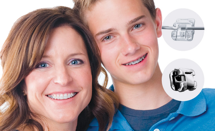 Damon braces